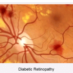 Diabetic Retina